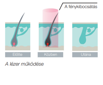 Dióda lézer a legjobb szőrtelenítő